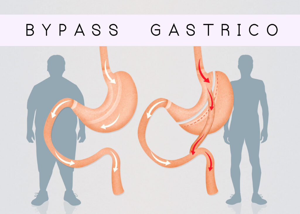 bypass bariatrica obesidade