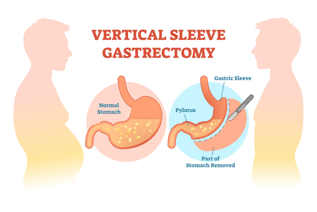 sleeve bariatrica gastrectomia vertical