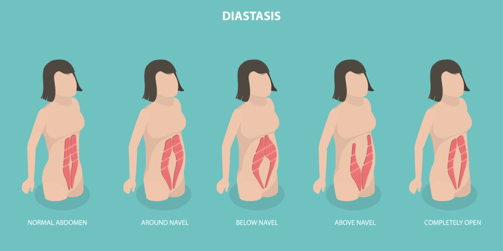 Diastase dos retos abdominais