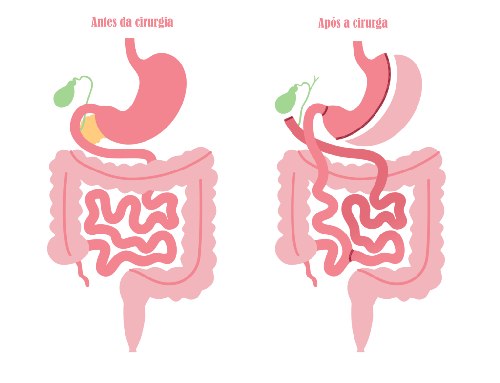 cirurgia bariatrica switch duodenal