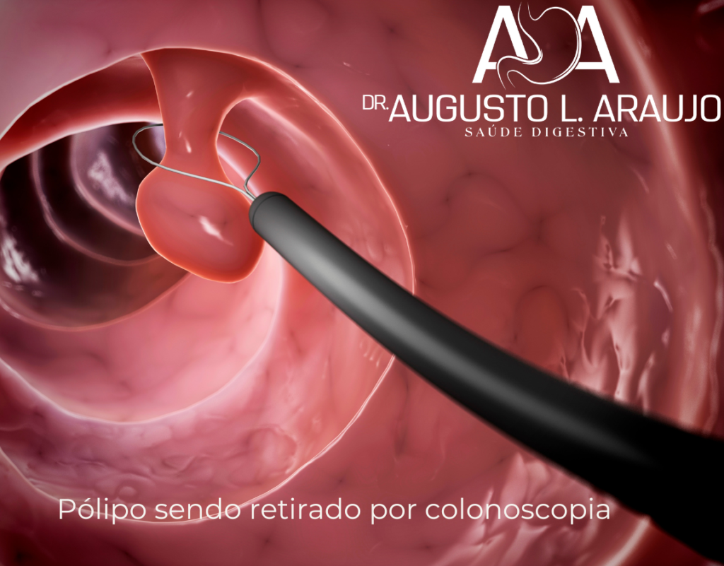 ColonoscopiaPolipo no colon