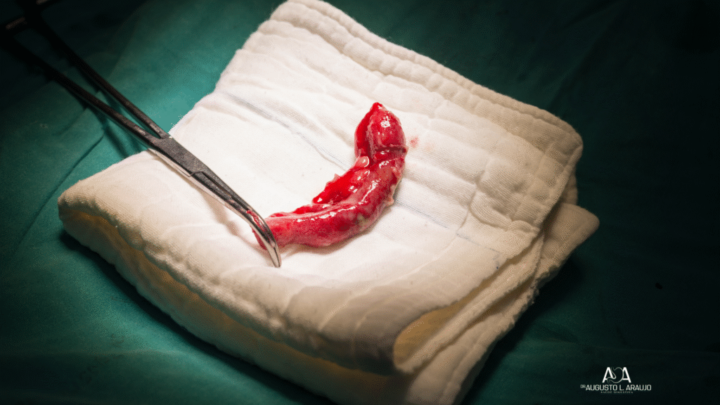 Cirurgia para apendicite aguda